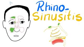 Rhinosinusitis Acuteamp Chronic Clinical Picture Diagnosisamp Management  Cases [upl. by Hedi]