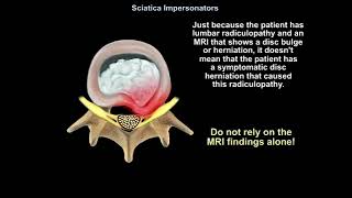 Sciatica Impersonators Explained Top Causes Symptoms and Treatments You Must Know [upl. by Eiba134]