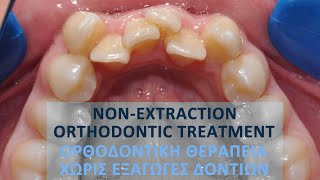 Nonextraction orthodontic treatment Pt BE [upl. by Aneroc297]