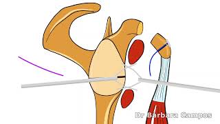 Arthroscopic Latarjet [upl. by Kasper]