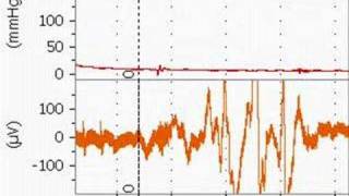 Bupivacaine Cardiotoxicity in an Anesthetized Rat [upl. by Tegdirb]