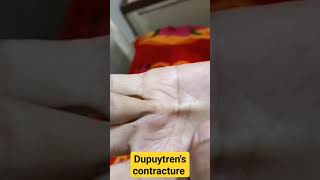 Dupuytrens contracture in chronic liver disease patientidentifydiagnosisliverdisease [upl. by Niotna]