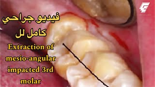 Surgical extraction of Mesioangular impacted 3rd molar  عزت شومان [upl. by Mcdougall]