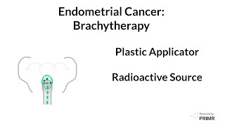 Endometrial Cancer  Brachytherapy [upl. by Latouche]