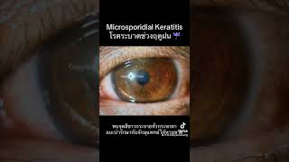 โรคระบาดช่วงหน้าฝน microsporidia keratitis [upl. by Etom]