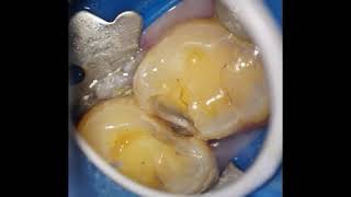 DIFFICULT MOLAR CLASS 2 DIRECT COMPOSITE RESTORATION [upl. by Ysnil]