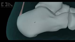 MinimallyInvasive Haglunds Deformity Surgery [upl. by Pride]