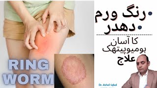 RINGWORM TREATMENT WITH HOMOEOPATHIC MEDICINESरिंग वर्म ट्रीटमेंटURDUHINDI DR AZHAR IQBAL [upl. by Tamah184]