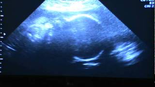 31 weeks ultrasound [upl. by Damian]