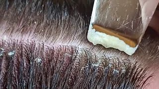 Scalp Treatment for Severely Dry Scalp [upl. by Narret995]