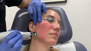 VBeam Perfecta pulse dye laser treatment for facial redness and rosacea by Dr Shaun Patel [upl. by Annaeel]