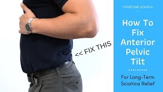 How to Fix an Anterior Pelvic Tilt for Sciatica Pain Relief [upl. by Akimed747]