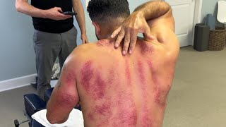 Extreme TOXIC Release 😳 Miracle Cracks Relieve MANS Pain  GuaSha  HUGE Purple BRUISING [upl. by Dinnage612]