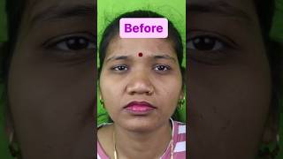 Before amp After Rhinoplasty Results nosejob [upl. by Jarvey]