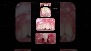 வாயில் ஏற்படும் பூஞ்சை தொற்று Oral Thrush Dr Isacc Abbas [upl. by Wight]