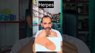 Herpes kya hota haiHerpes1Herpes2 [upl. by Obeded924]