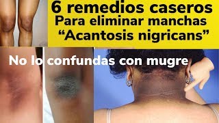 6 remedios caseros para eliminar manchas quotAcantosis nigricansquot [upl. by Pasahow]