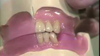 Setting Mandibular Anterior Teeth [upl. by Isolde977]