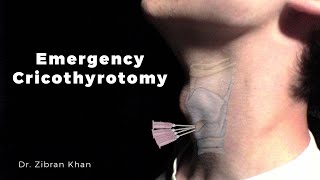 Emergency Cricothyrotomy at a Dental Office  Dr Zibran Khan [upl. by Anahpos]