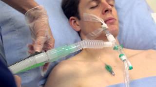 Using Intersurgicals TrachSeal™ closed suction systems [upl. by Okier566]