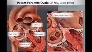 Patent foramen ovale PFO Part II [upl. by Elocaj]