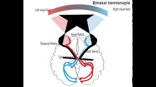 binasal hemianopia [upl. by Nwahsid]