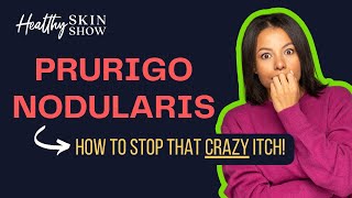 What is PRURIGO NODULARIS Treatment to STOP the CRAZY ITCH  Shawn Kwatra [upl. by Elpmet]