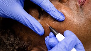 Skin Tags Removal with Electrolysis [upl. by Hedwiga]