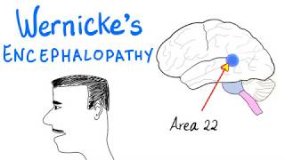 Wernickes Aphasia Fluent Aphasia  Neurology [upl. by Cammi13]