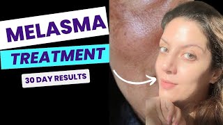 How to remove Melasma at home  Visible results in 30 days  Full AM PM routine to treat Melasma [upl. by Lynnett]