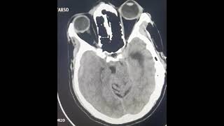 SDH  acuteonchronicsdh  ctscan craniotomy  urgent burr hole or craniotomy [upl. by Henrie]