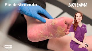 Afección extrema en manos y pies Dra Emma Clínica dermatológica [upl. by Munsey163]