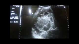 ultrasound of a RETROPERITONEAL MASS part 1a [upl. by Florence]