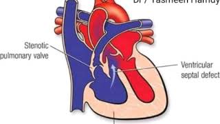 💛 pediatrics 💛 cardio 💙 tetralogy of fallot 💚 [upl. by Ainegue543]