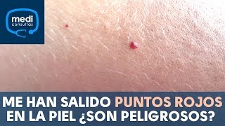 Me han salido puntos rojos en la piel ¿son peligrosos MediConsultas [upl. by Ellehcin]