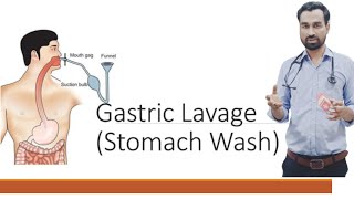 GASTRIC LAVAGE STOMACH WASH STOMACH IRRIGATION ICU PROCEDURE DR SALMAN NASIR [upl. by Therine]