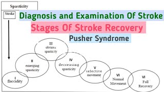 Diagnosis And Examination Of StrokeStages Of Stroke RecoveryPusher Syndrome [upl. by Dimo]