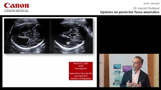 ISUOG 2018 Dr Laurent Guibaud  Updates on Posterior Fossa Anomalies [upl. by Aisereht665]