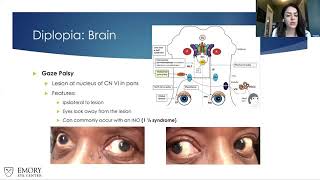 Lecture Prescribing Prism for Diplopia in NeuroOphthalmic Disorders Part II [upl. by Llezo]