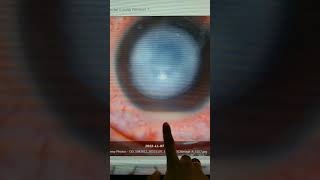 hypopyon corneal ulcers diagnosis optometrists treatments eye oci keratoconus ophthalmology [upl. by Ewen]