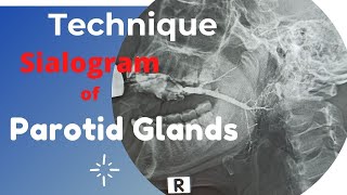 Sialogram of Parotid gland Ep53  Technique of parotid gland  procedure of parotid gland [upl. by Tollman462]