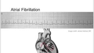 Tachycardia Basic Discussion [upl. by Ziza]