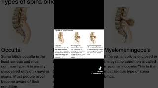 Types of Spina Bifida 💛 SpinaBifida SpinaBifidaAwareness [upl. by Esilec687]