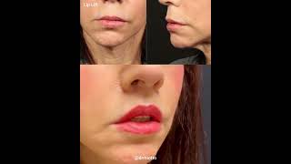 Lip Lift Surgeon in Atlanta GA  Dr Miotto  Atlanta Plastic Surgeon [upl. by Crooks]