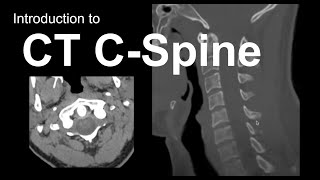 Introduction to CT Cspine Approach and Essentials [upl. by Weasner390]