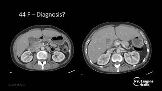 Imaging findings in Pancreatitis [upl. by Gustave]