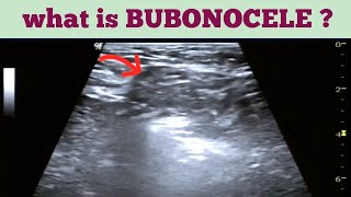 Bubonocele  Inguinal Ultrasound [upl. by Carolann]