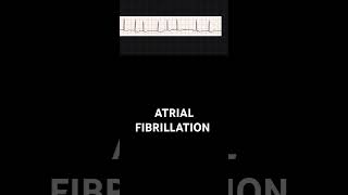 how to identify Atrial fibrillation in an ECGEKG [upl. by Ailasor]