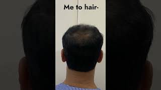 Unbelievable Hair Transplant Results Dr Arth Shah Transforms Life hairtransplantresults [upl. by Aroc549]