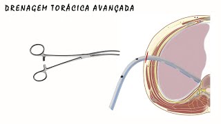 TORACOSTOMIA COM DRENAGEM FECHADA VISTA TRANSVERSAL [upl. by Trip]